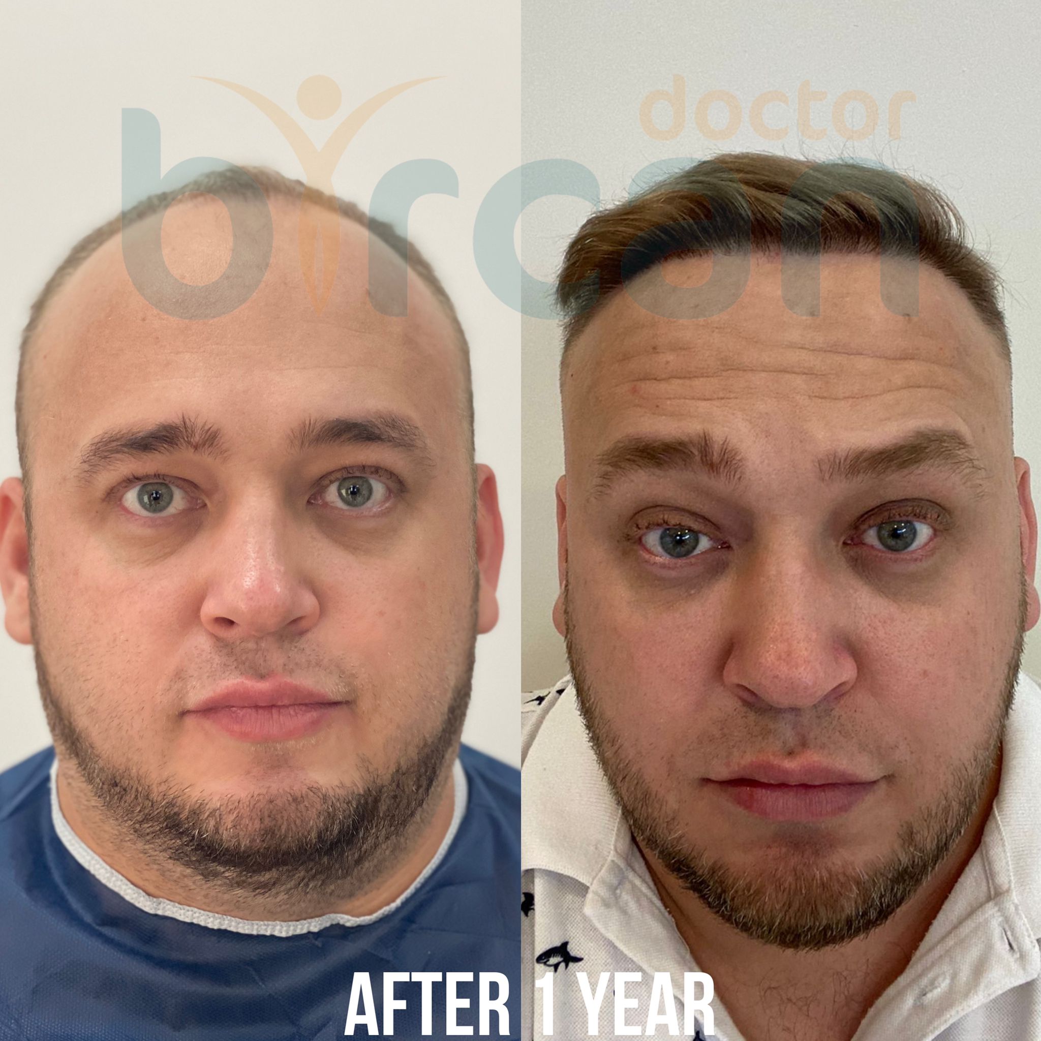 doctor-bircan-customer-before-after-photo