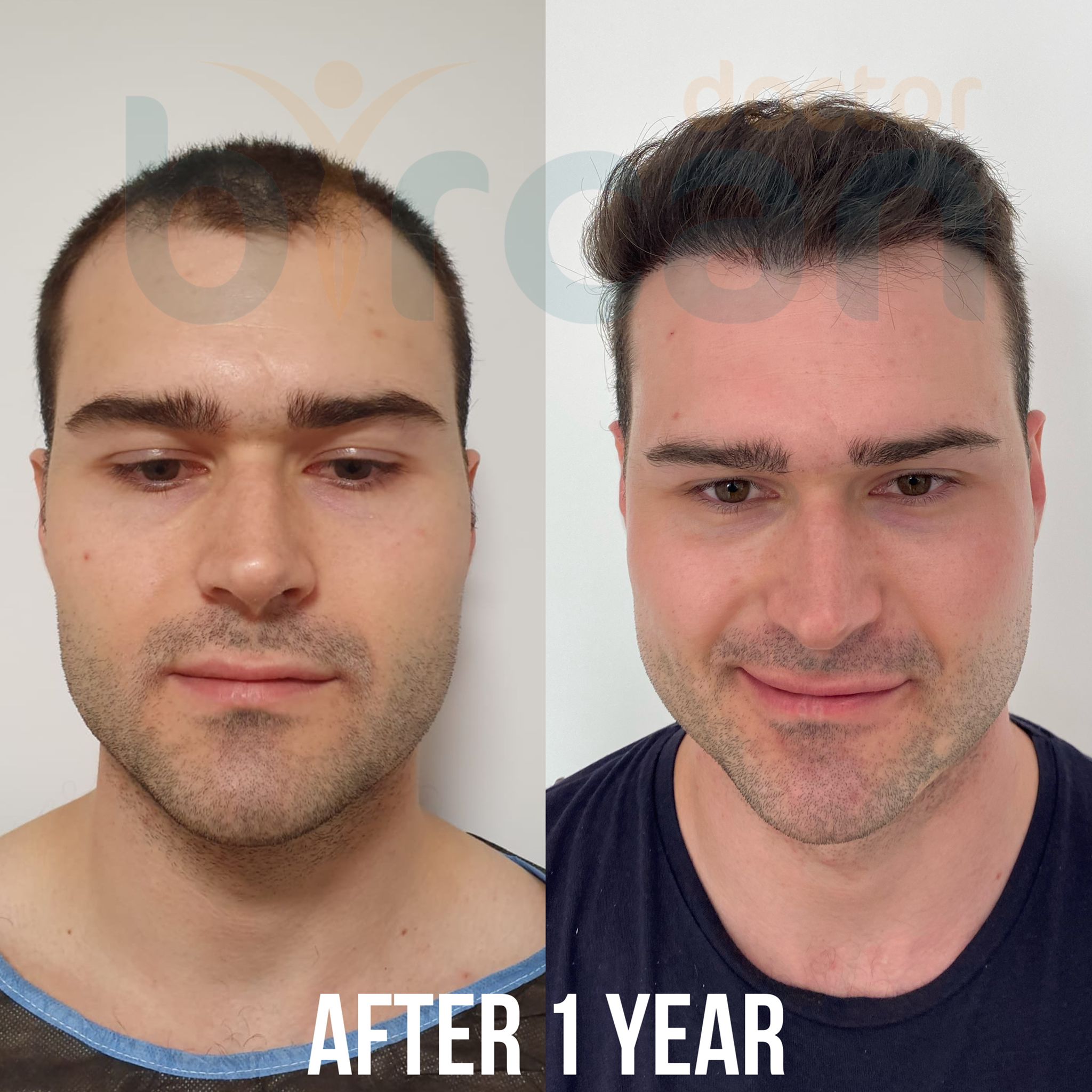 1year before after 3