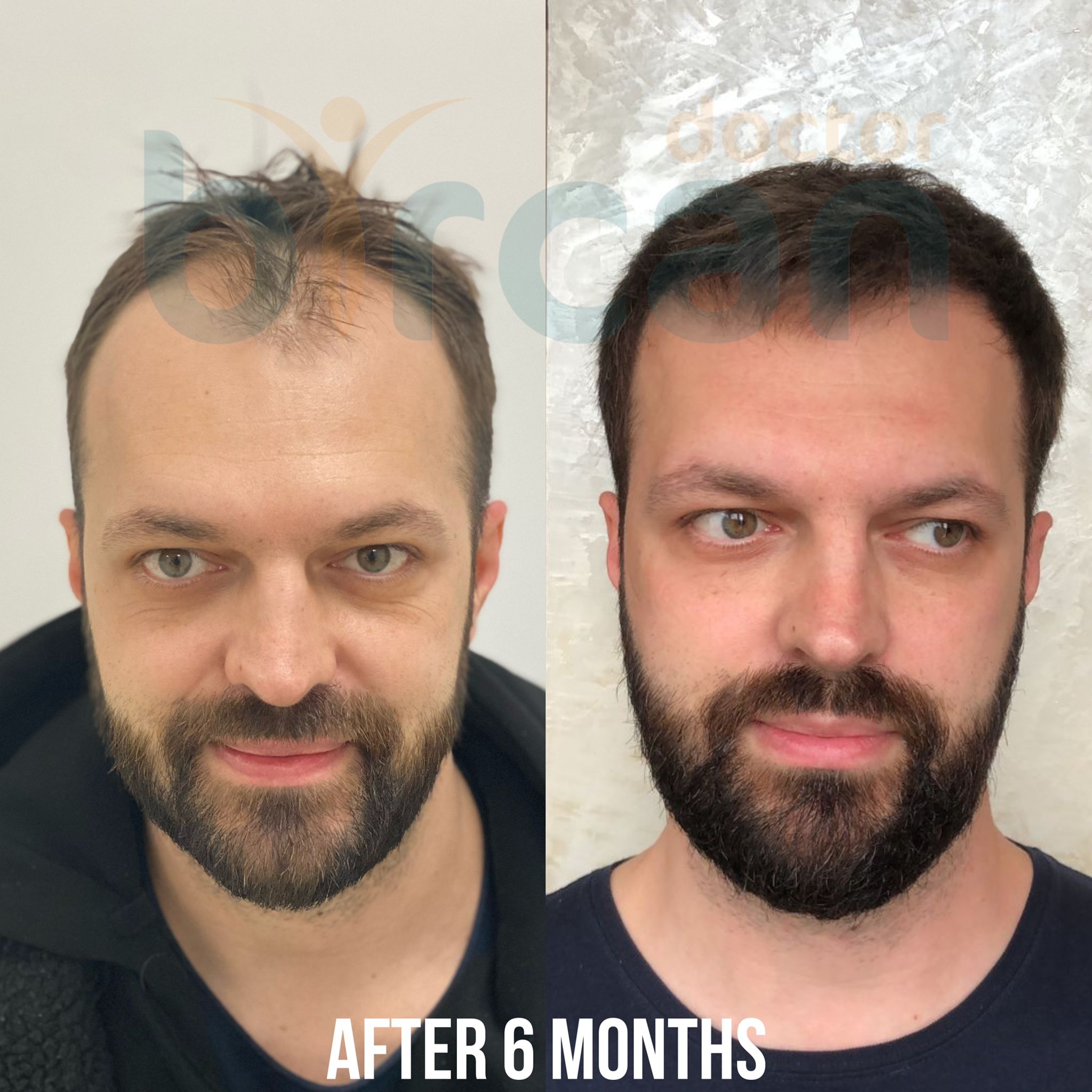 6months before after