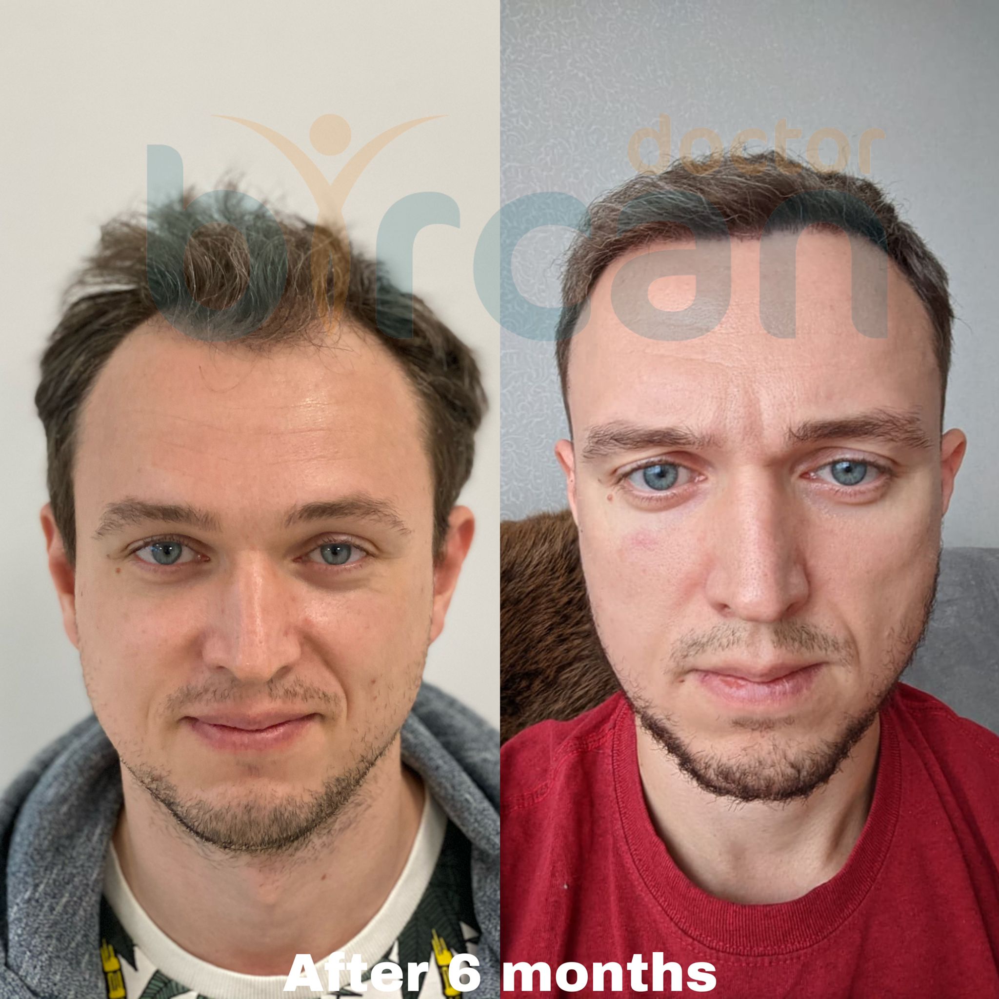 6months before after2