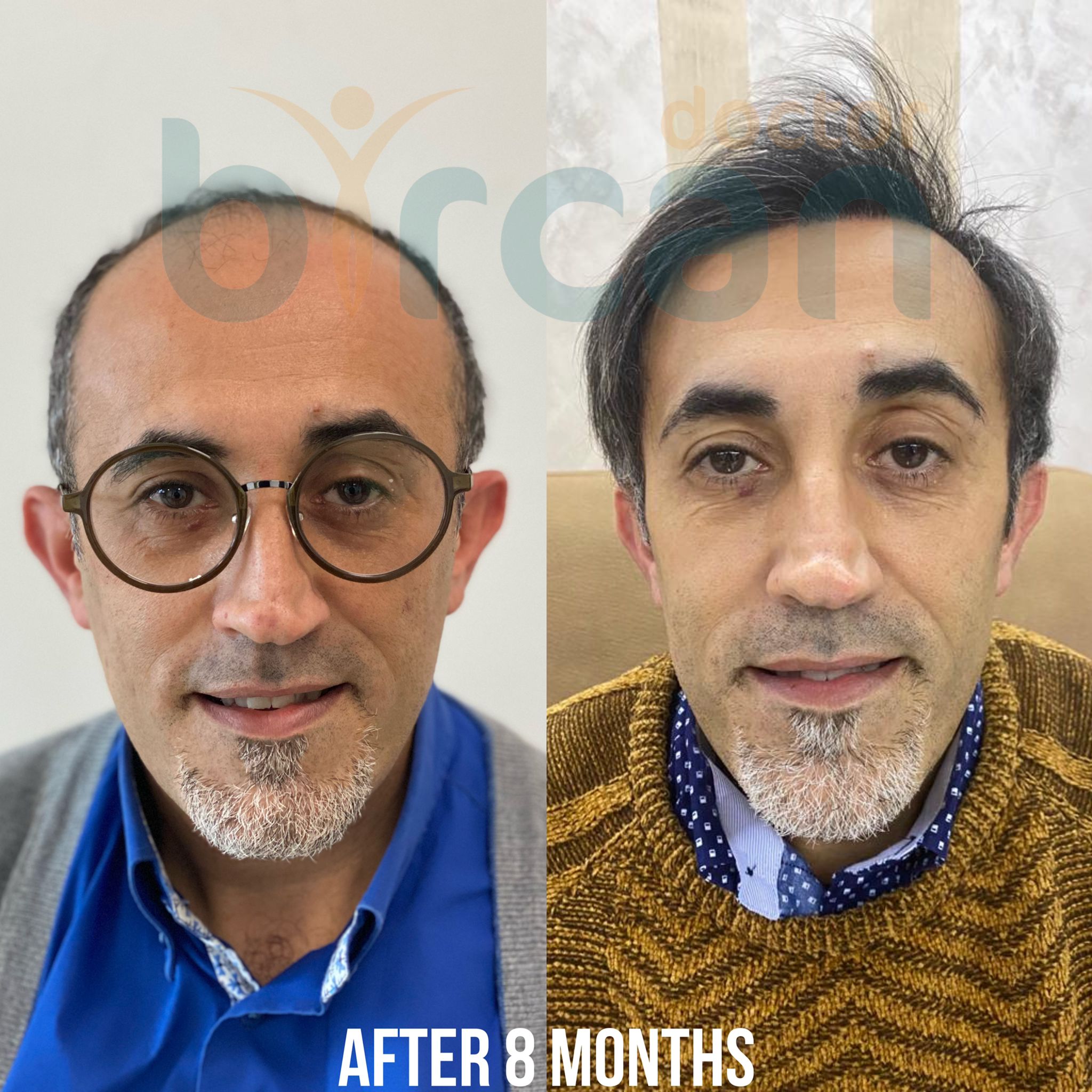 8months before after6