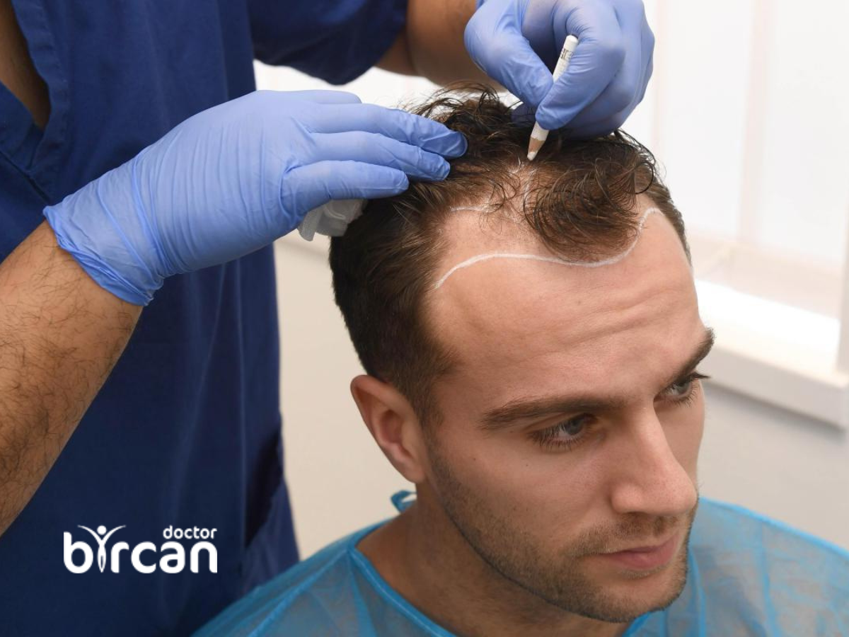 Do The Person Have To Be Completely Bald During The Hair Transplant? » Dr.  Gökhan Bircan