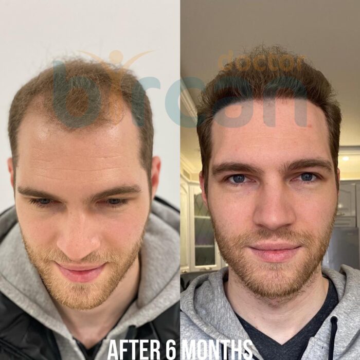 Hair Transplant Results After 6 Months | Progress & Images