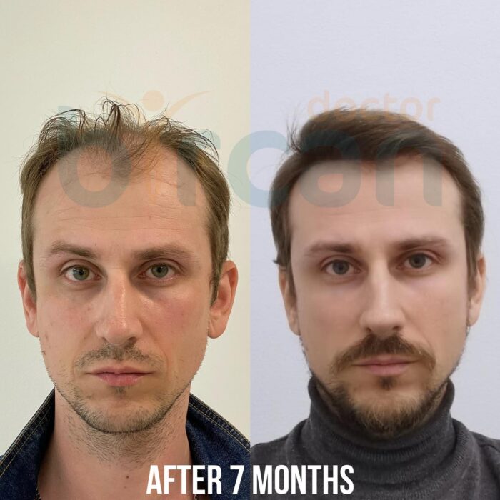 Cost of Hair Transplant in Bangalore | RootzHair