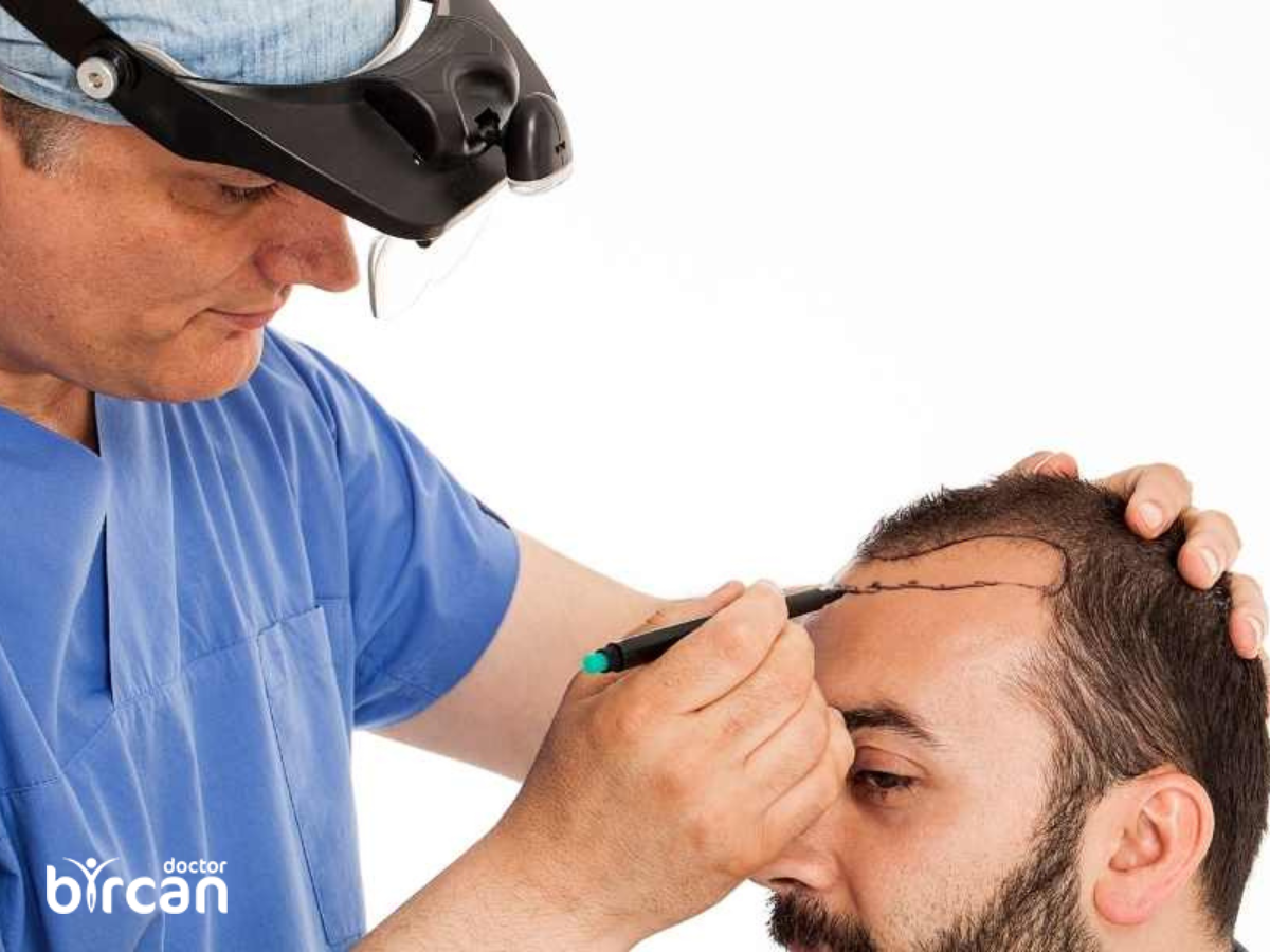 How is Hair Transplant from Beard to Head done? » Dr. Gökhan Bircan