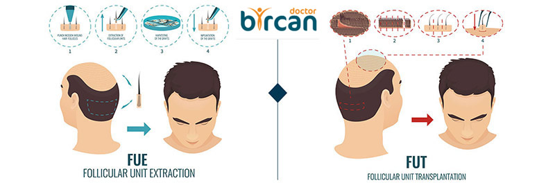 Hair Transplant Process » Dr. Gökhan Bircan