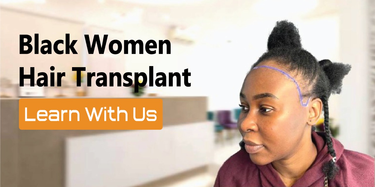 Black Women Hair Transplant Hair Transplantation for Black Females » Dr.  Gökhan Bircan