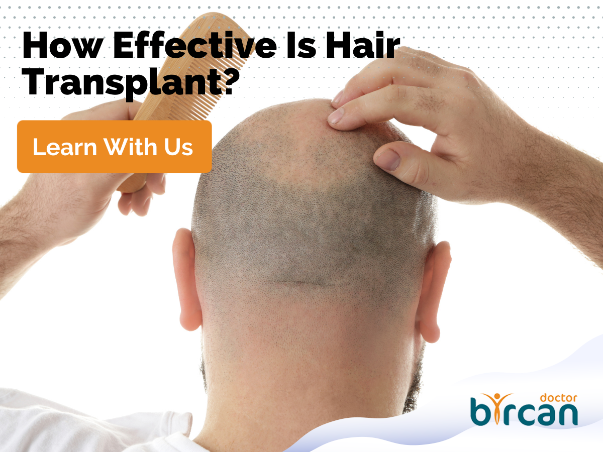 How Effective Is Hair Transplant