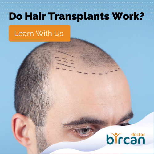 Do Hair Transplants Work? » Dr. Gökhan Bircan
