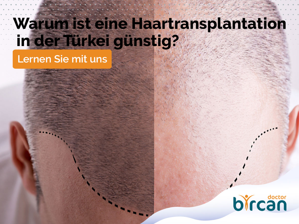 Warum ist eine Haartransplantation in der Türkei günstig?